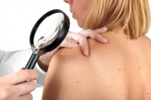 melanomafa