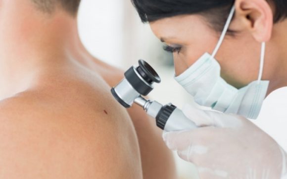 melanoma
