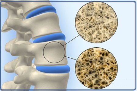 ostikinea